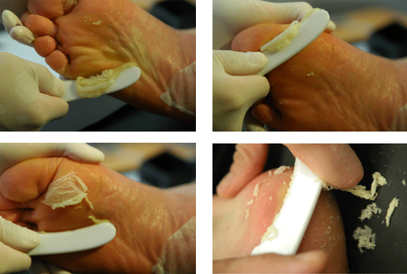 Peel off callus