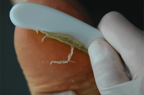 Peel off callus