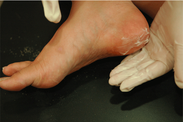 Callus peel Moisture cream